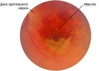 Возрастная макулодистрофия: как избежать