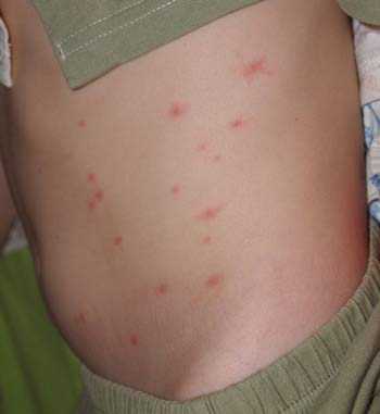 От того и чешется: что нужно знать о дерматите