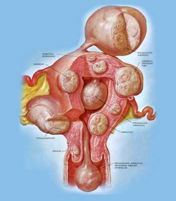 Миома матки, основные симптомы, виды и лечение