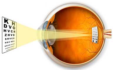 Астигматизм: описание, симптомы, лечение