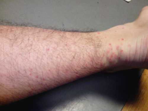 Чешутся вены на ногах и руках