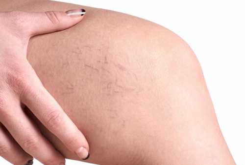 Их назначают, чтобы симптоматически лечить варикоз