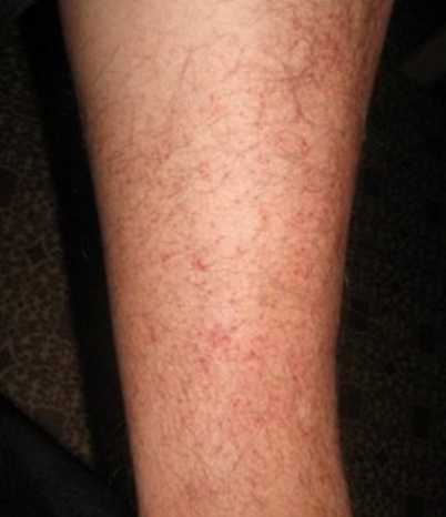 Успокоительные препараты используются не только для неврозов