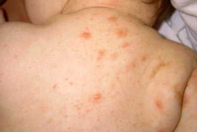 Выбор противочесо точных препаратов зависит от возраста пациента, тяжести заболевания и ограничивается изза потенциальной токсичности и аллерген ности скабицидов, в первую очередь, для новорожденных и грудных детей, беременных и кормящих женщин, а также больных с судорожным синдромом