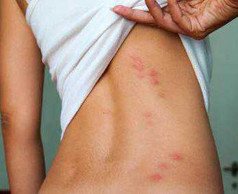 Арди наличие на локтях папуловезикул ярных элементов, покрытых геморрагическими и импетигинозными корками, симптом