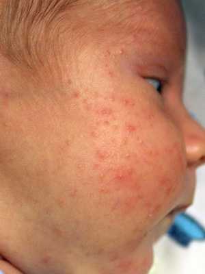 Гнойное воспаление потовых желез