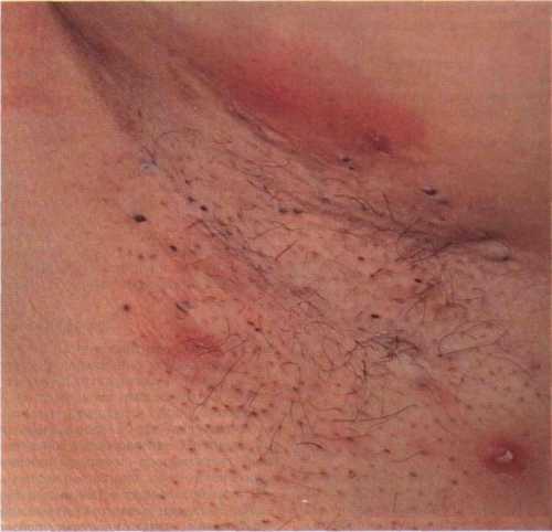 Чаще всего бывает в подмышечных впадинах