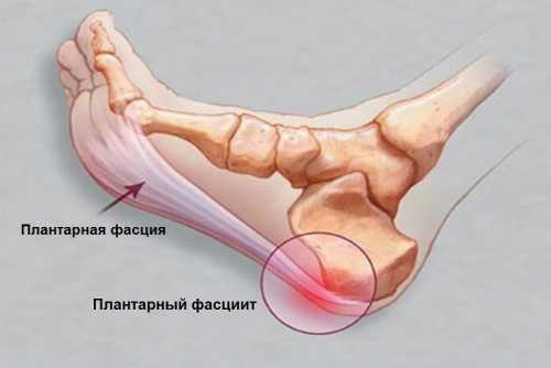 Болит пятка при ходьбе