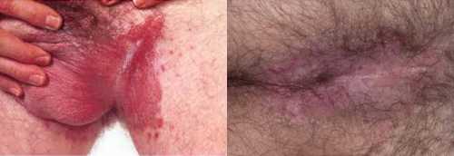 Если вовремя не озадачиться, как лечить молочницу у мужчин, то возникнут неприятные осложнения которые перечислены чуть ниже