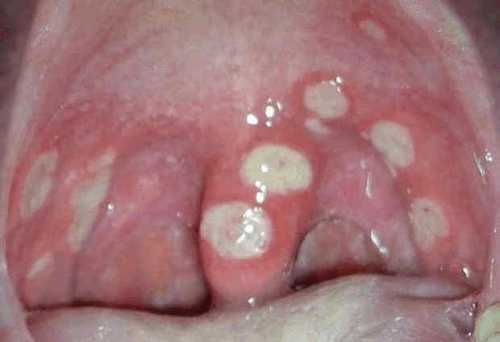 Молочница у мужчин: симптомы, причины, это