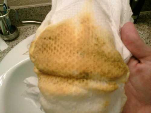 У младенцев такое состояние обычно бывает проходящим, но у некоторых дефицит лактазы может сохраниться, и тогда человеку приходится всю жизнь соблюдать специальную диету