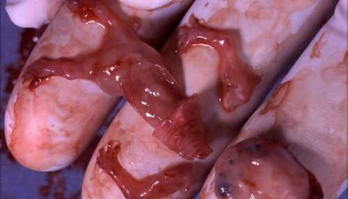 Как правило, врачи связывают данный тип выделения с менструальным циклом соответствующий дням до начала наступления беременности в первой его части наблюдаются малообильный секрет водянистой консистенции, который позже сменяется густой и тягучей субстанцией, полностью белого или бежевого оттенка