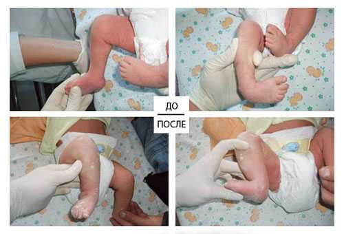 Косолапие у детей: лечение и осложнения