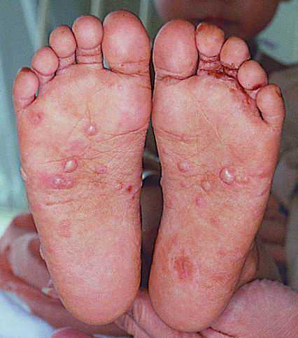 Лечение чесотки у детей можно проводить и в домашних условиях, если будет предупреждено повторное заражение малыша