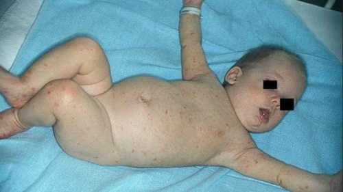 Чесотка у детей