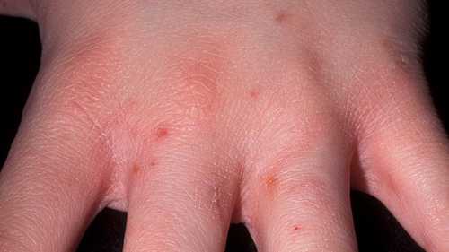 Их возникновение специалисты связывают с около сосудистой ин фильтрацией дермы и увеличением лимфовидной ткани, расположенной под чесоточными ходами, возникающей изза повышенной чувствительности организма ребенка к продуктам жизнедеятельности паразита