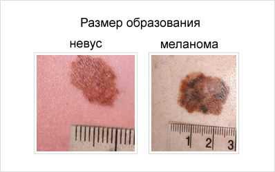 При меланоме пигментные пятна выглядят неравномерно с обеих сторон