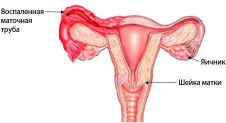 Воспаление придатков: симптомы, причины, это