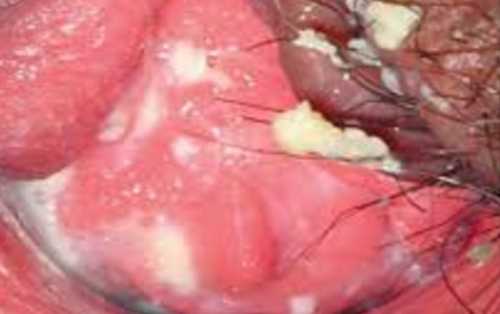 Бактериальный вагиноз