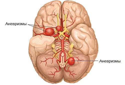 Аневризма сосудов головного мозга