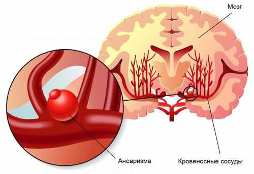Далеко не во всех случаях происходит разрыв аневризмы